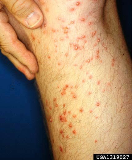 Red stings on leg from fire ants