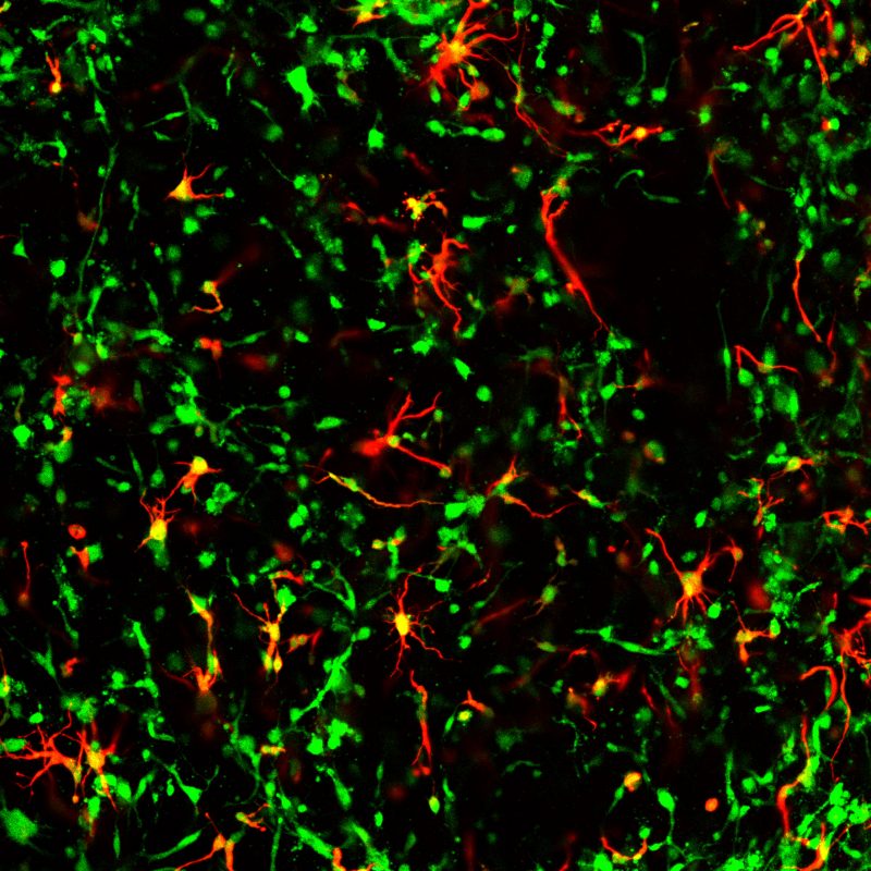 Astrocytes (red) infiltrated with tumor cells (green)